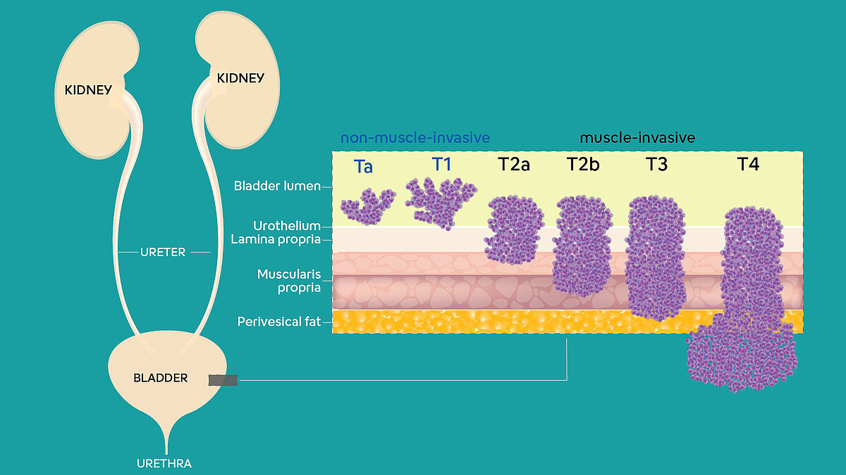 Illustration of urinary tract including kidneys, ureters, bladder and urethra, as well an illustration showing the different stages of bladder cancer.