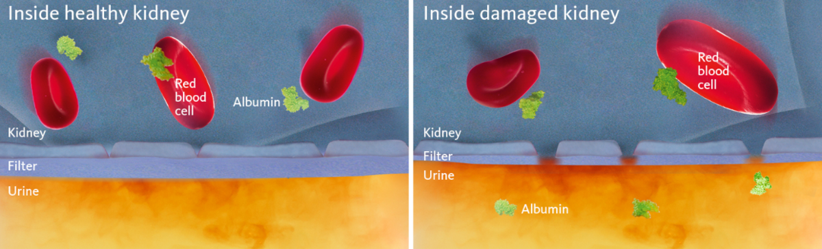 [.NO-no Norway (norwegian)] •	Schematic and simplified view of a healthy and a damaged kidney membrane with the latter illustrating the cause of albuminuria.