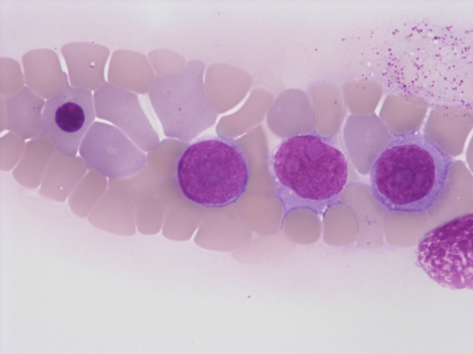 Breast carcinoma cells on blood film