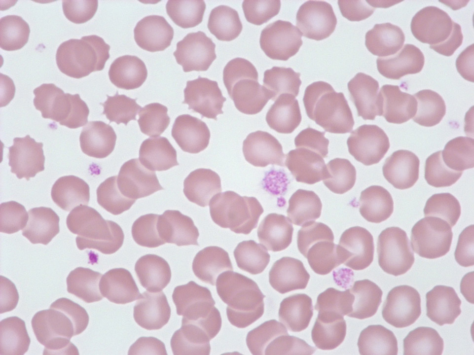 Anisocytosis of platelets