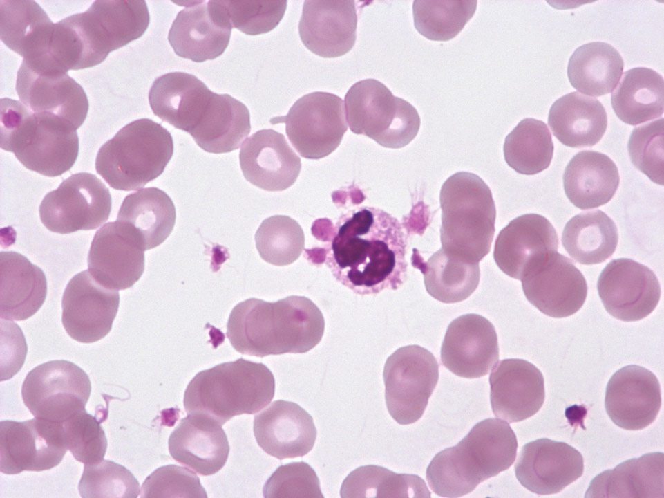 Accumulation of platelets on granulocytes