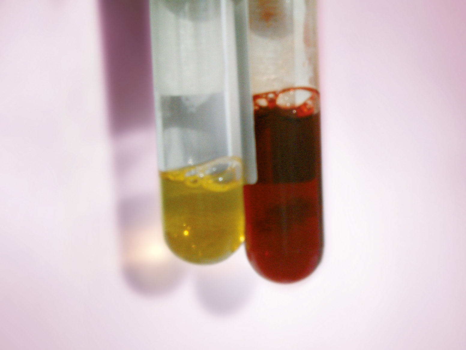 Blood sample reflecting acute intravascular haemolysis