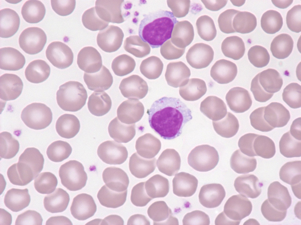 T-cell large granular lymphocytic (LGL) leukaemia