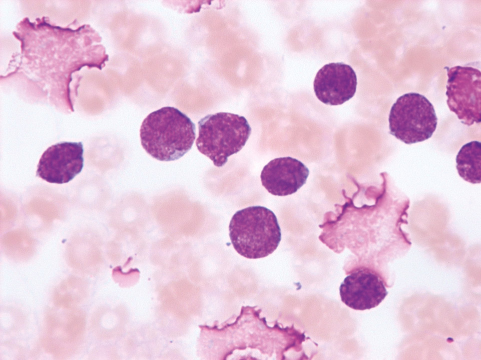 Acute T lymphoblastic leukaemia (T-ALL)