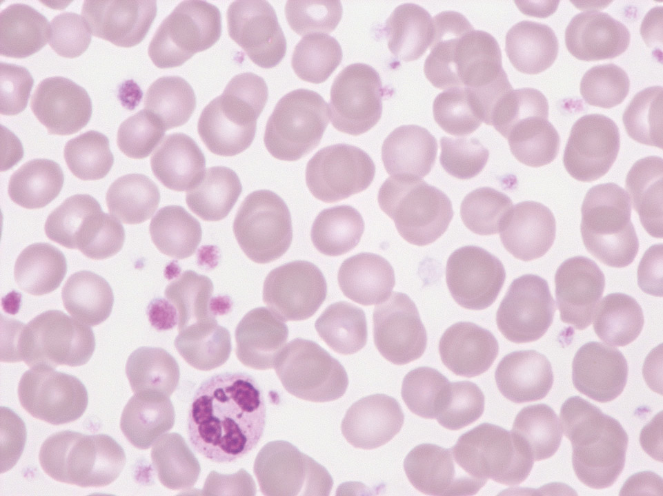 Thrombocytosis and platelet anisocytosis