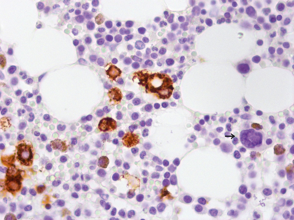 Bone marrow histology of a patient with breast cancer