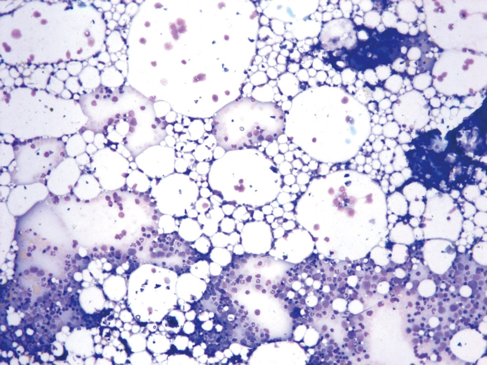Bone marrow cytology of a patient with aplastic anaemia